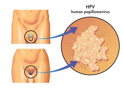 زیگیل تناسلی یا HPV چیست؟