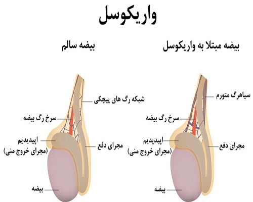 درمان واریکوسل با بهترین روش های طب سنتی